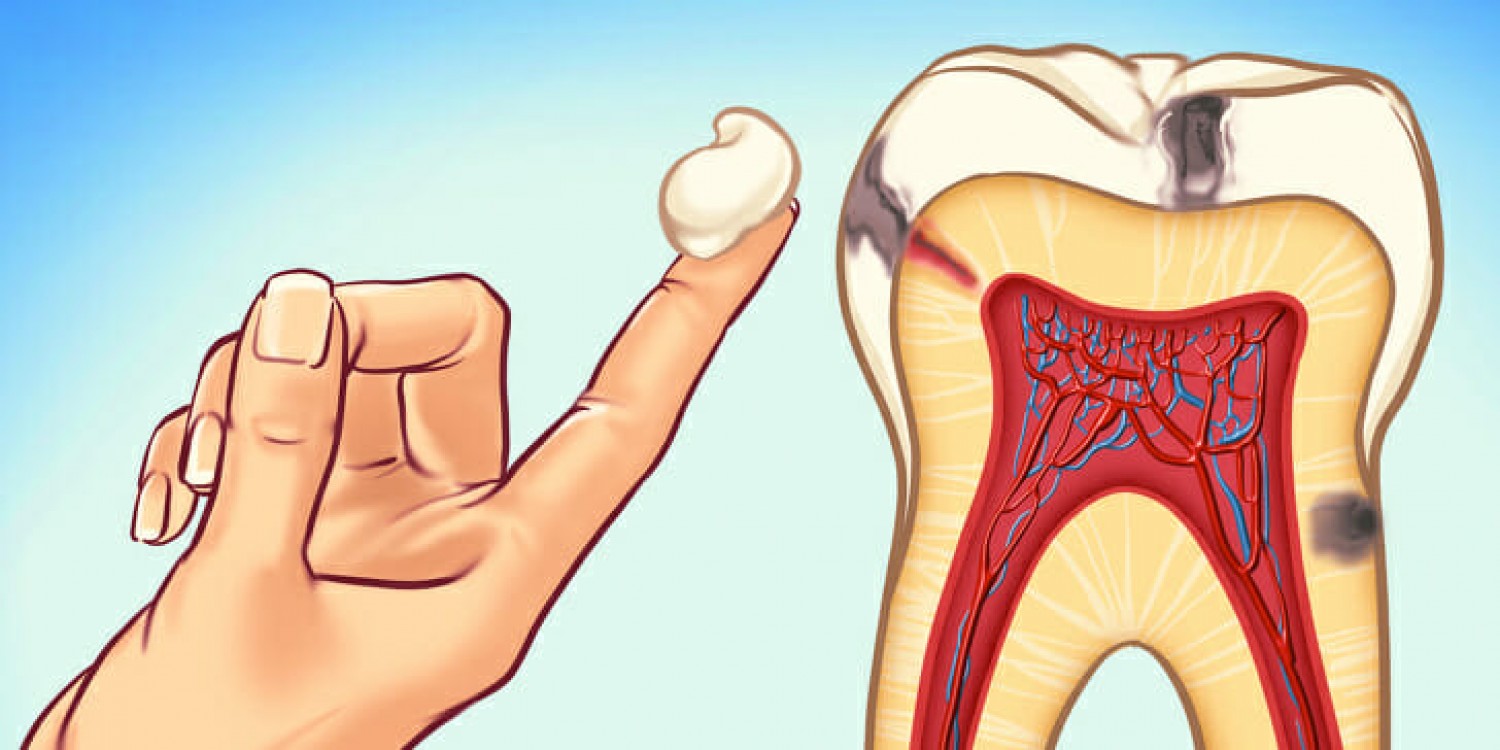 5 módszer - Ha fáj a fogad, a gyógyszerek helyett ezeket próbáld ki!