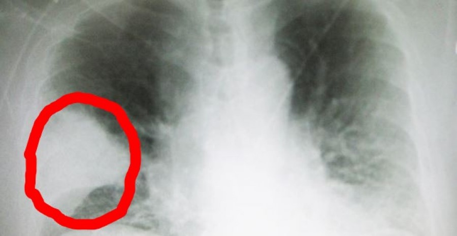 7 jel, amiből felismerheted, hogy tüdőgyulladásod van